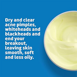 NEW MAX STRENGTH 10% SULPHUR OINTMENT SULFUR CREAM ACNE BLACKHEAD SPOT CYST ZIT CURE OILY SKIN BLOCKED PORES MEDICATED TREATMENT