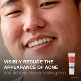 Neutrogena Rapid Clear Stubborn Acne Spot Gel Pimple Cream for Acne Prone Skin Care 28g (Pack of 1)